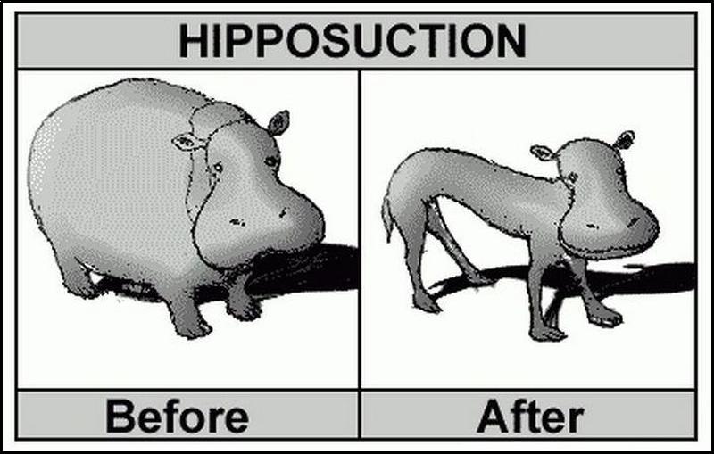 hipposuction.jpg