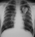 rentgenova-snimka-na-razbito-surce