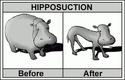 hipposuction