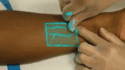 how to locate blood vessels quick and easy with infrared