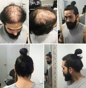 baldness solution